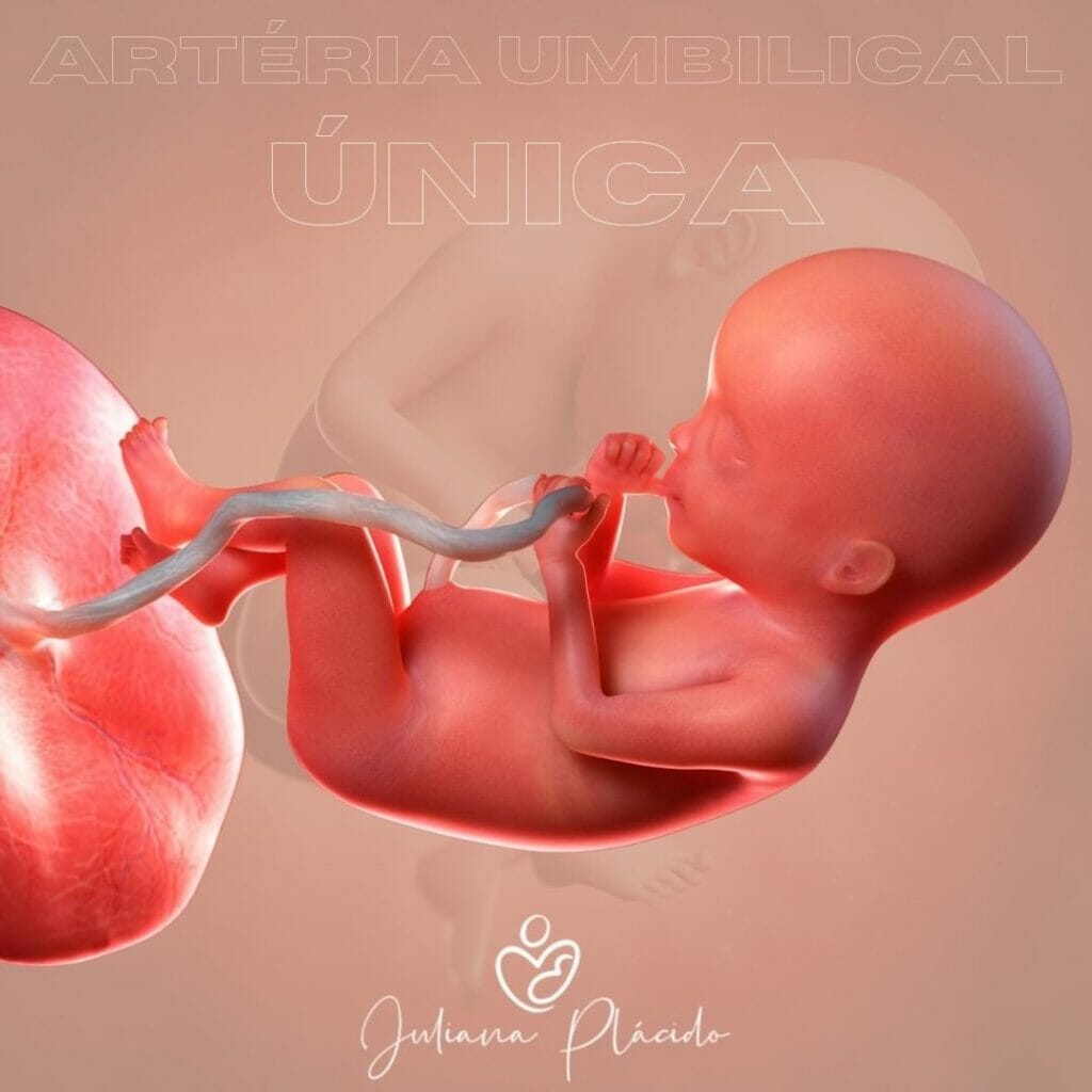 Artéria Umbilical Única